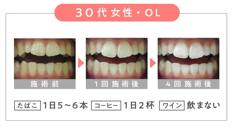 \ 30代 女性・OL /【 たばこ 】1日5~6本【 コーヒー 】1日2杯 【 ワイン 】飲まない